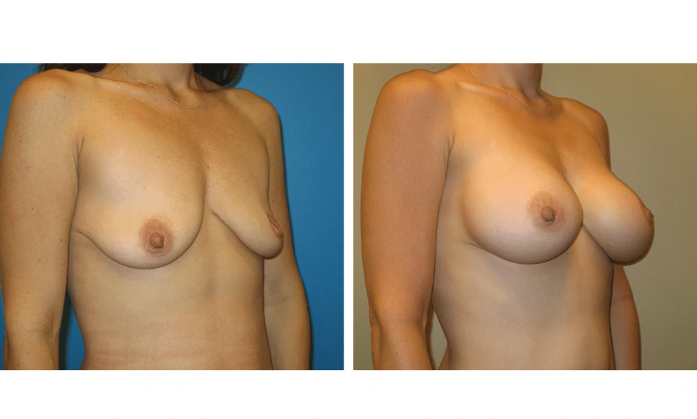 Breast Augmentation - Case 10 (2)