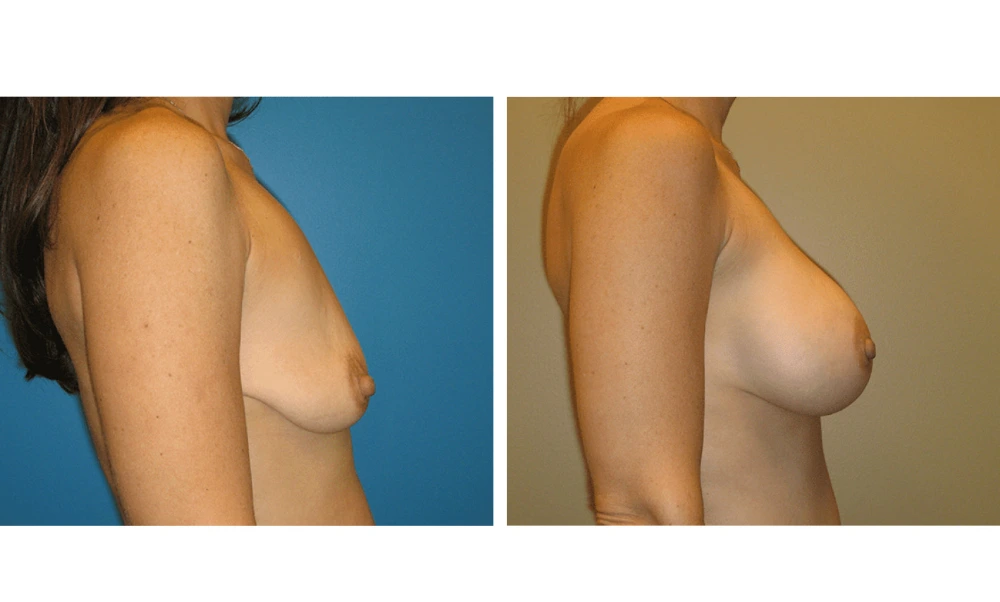 Breast Augmentation - Case 10 (3)