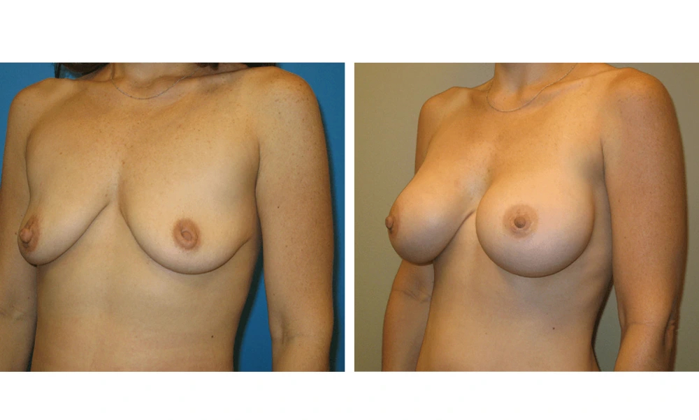 Breast Augmentation - Case 10 (4)