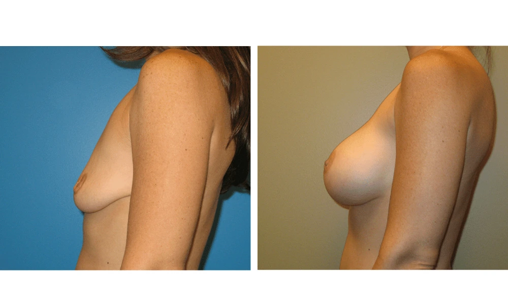 Breast Augmentation - Case 10 (5)