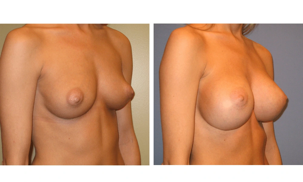 Breast Augmentation - Case 12 (2)