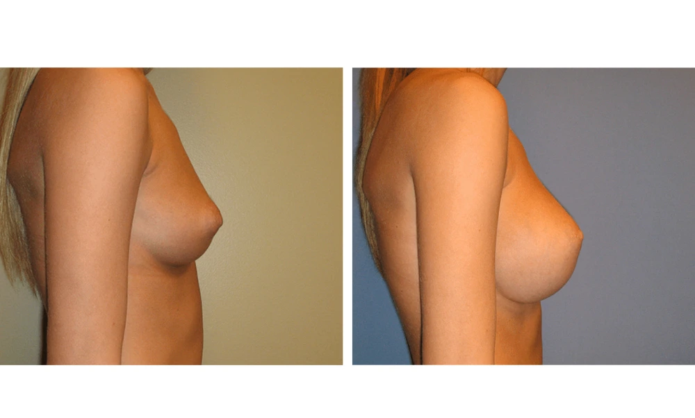 Breast Augmentation - Case 12 (3)
