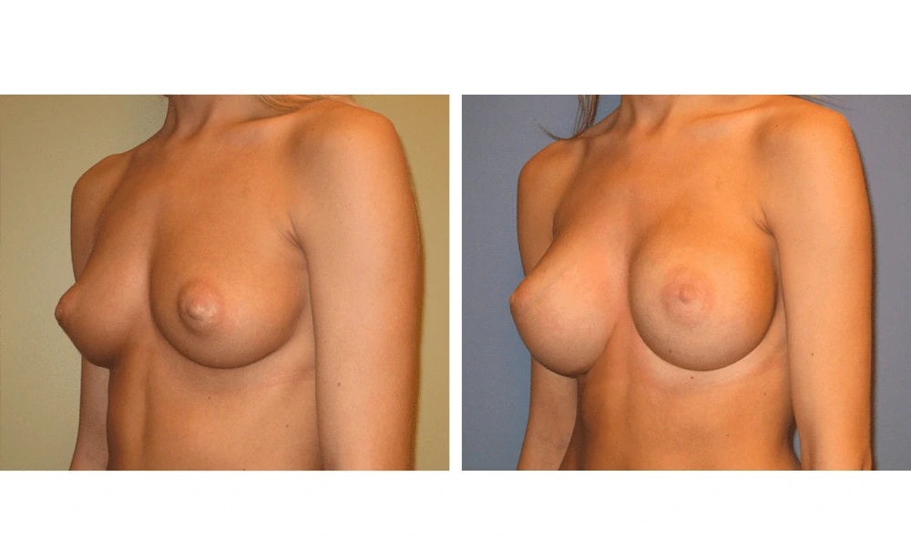 Breast Augmentation - Case 12 (4)