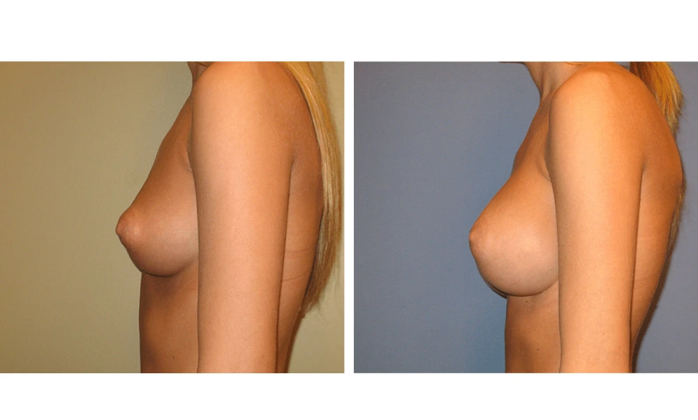 Breast Augmentation - Case 12 (5)