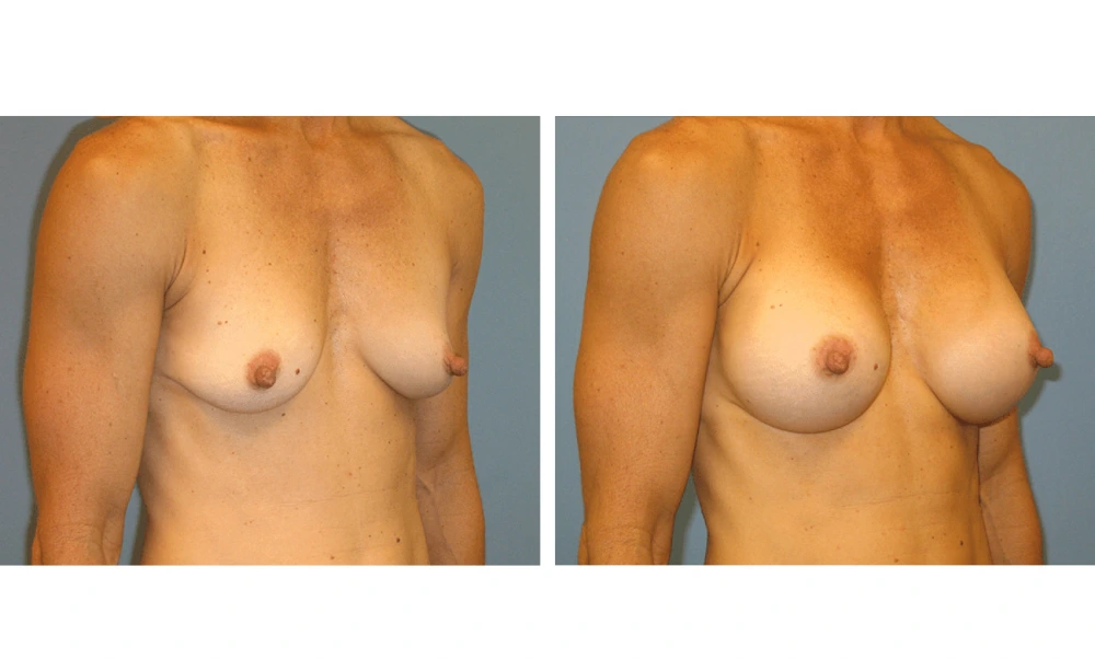 Breast Augmentation - Case 13 (2)