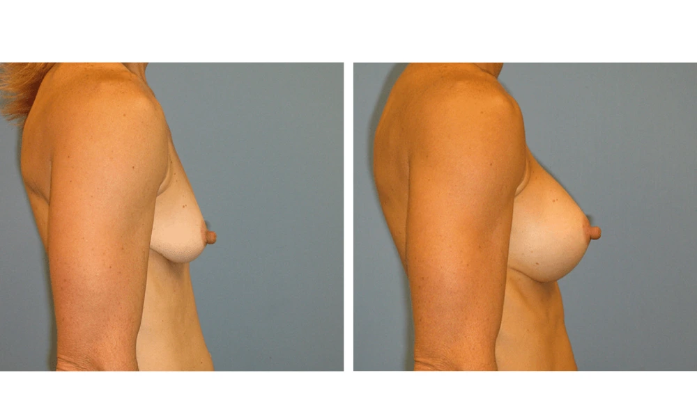 Breast Augmentation - Case 13 (3)
