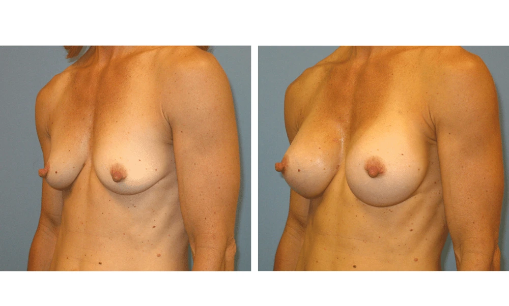 Breast Augmentation - Case 13 (4)