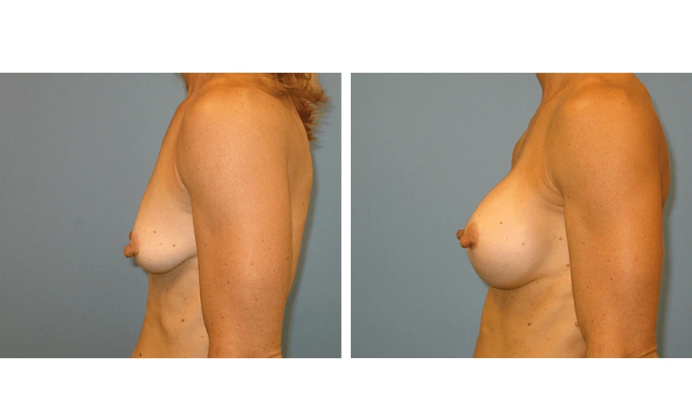 Breast Augmentation - Case 13 (5)
