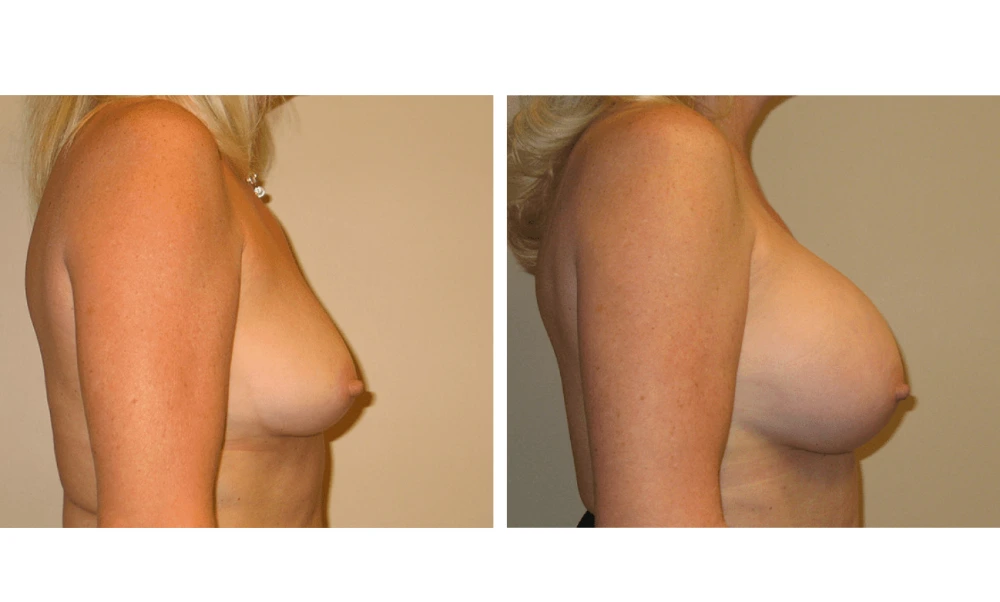 Breast Augmentation - Case 14 (3)