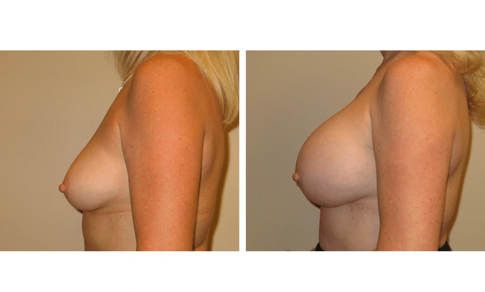 Breast Augmentation - Case 14 (5)