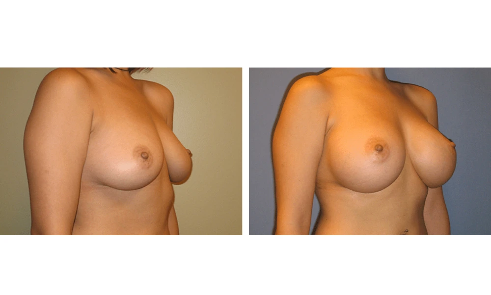 Breast Augmentation - Case 15 (2)