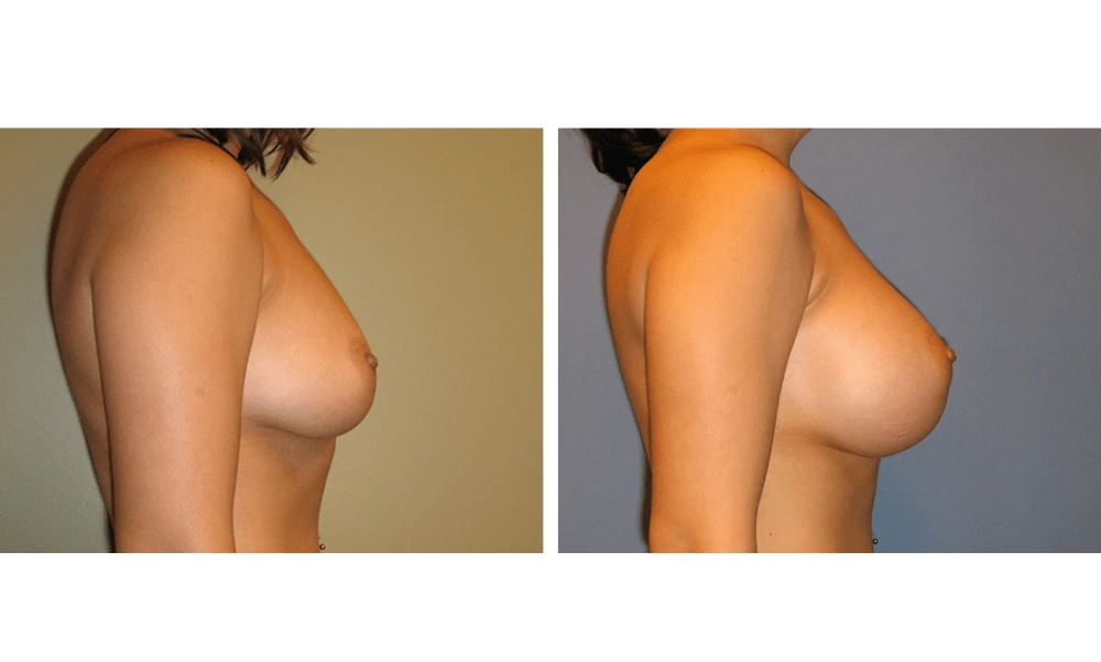 Breast Augmentation - Case 15 (3)