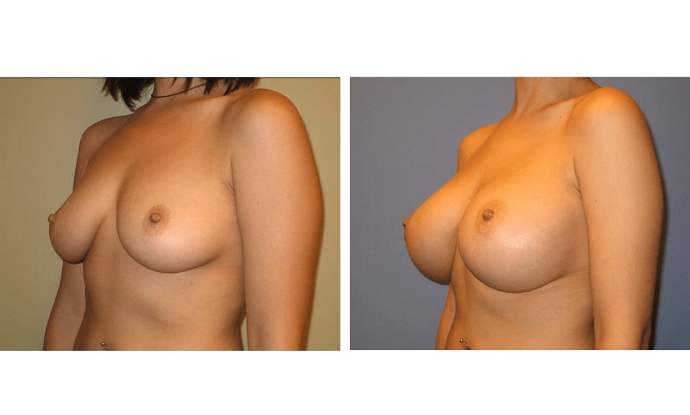 Breast Augmentation - Case 15 (4)