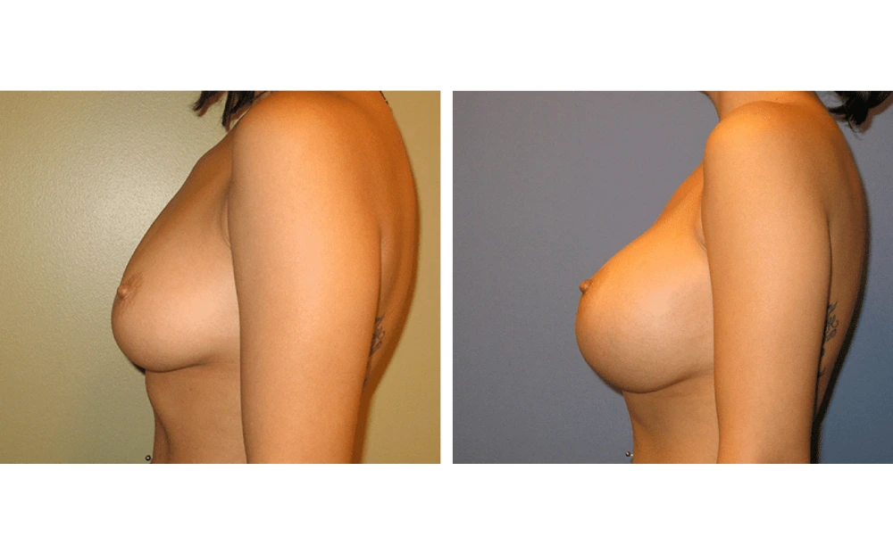 Breast Augmentation - Case 15 (5)