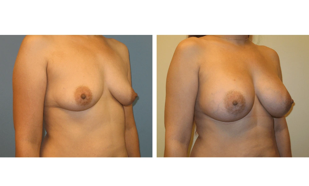 Breast Augmentation - Case 16 (2)