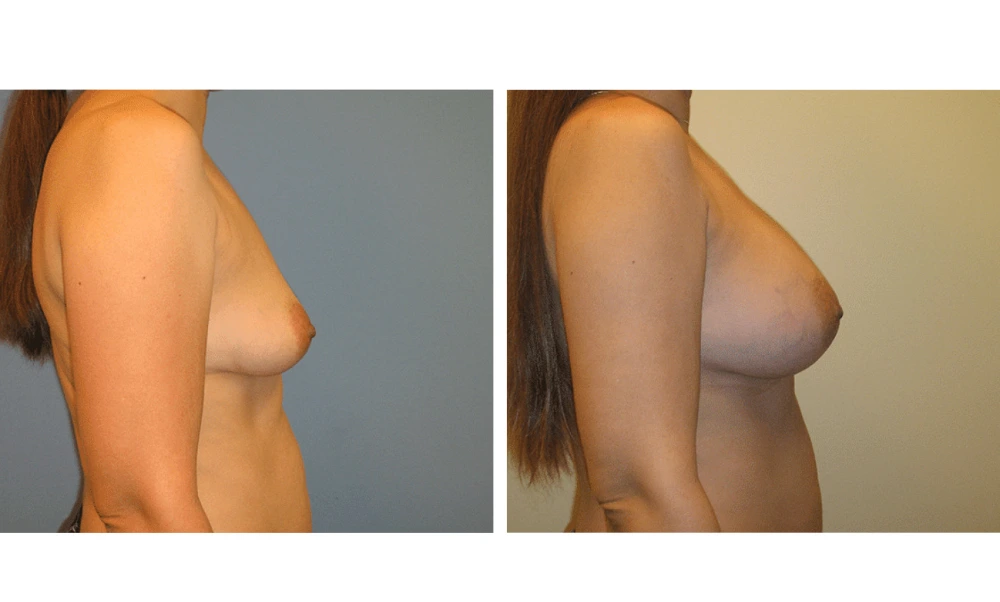 Breast Augmentation - Case 16 (3)