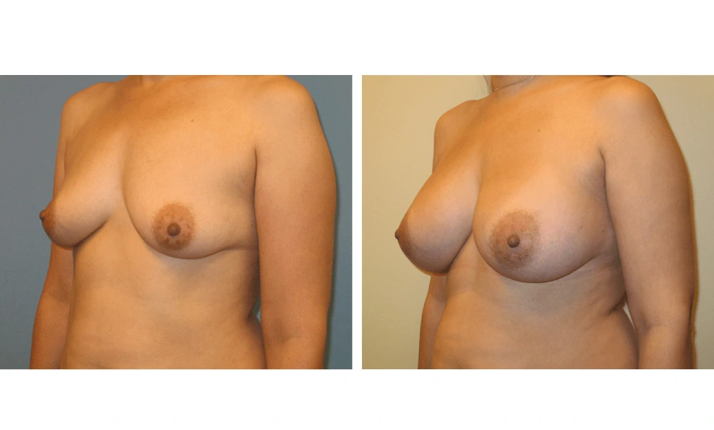Breast Augmentation - Case 16 (4)