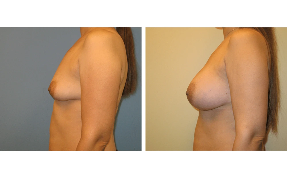 Breast Augmentation - Case 16 (5)