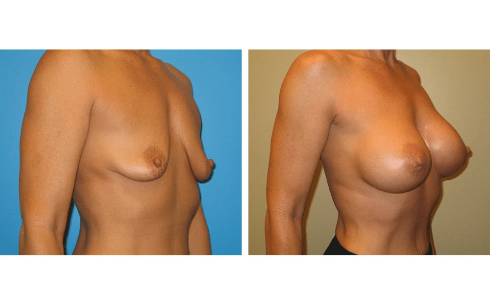 Breast Augmentation - Case 17 (2)