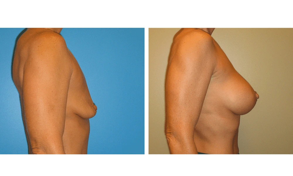 Breast Augmentation - Case 17 (3)