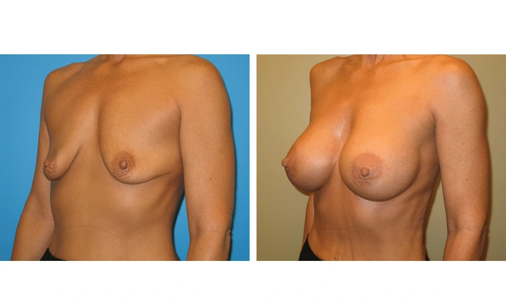Breast Augmentation - Case 17 (4)