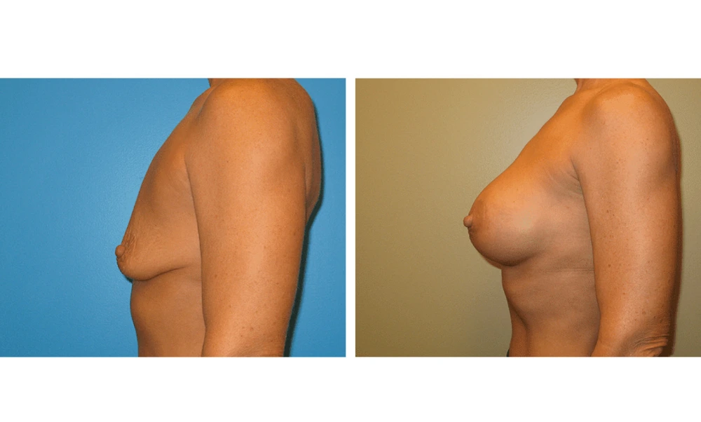 Breast Augmentation - Case 17 (5)