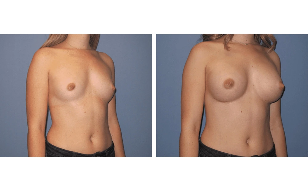 Breast Augmentation - Case 18 (2)