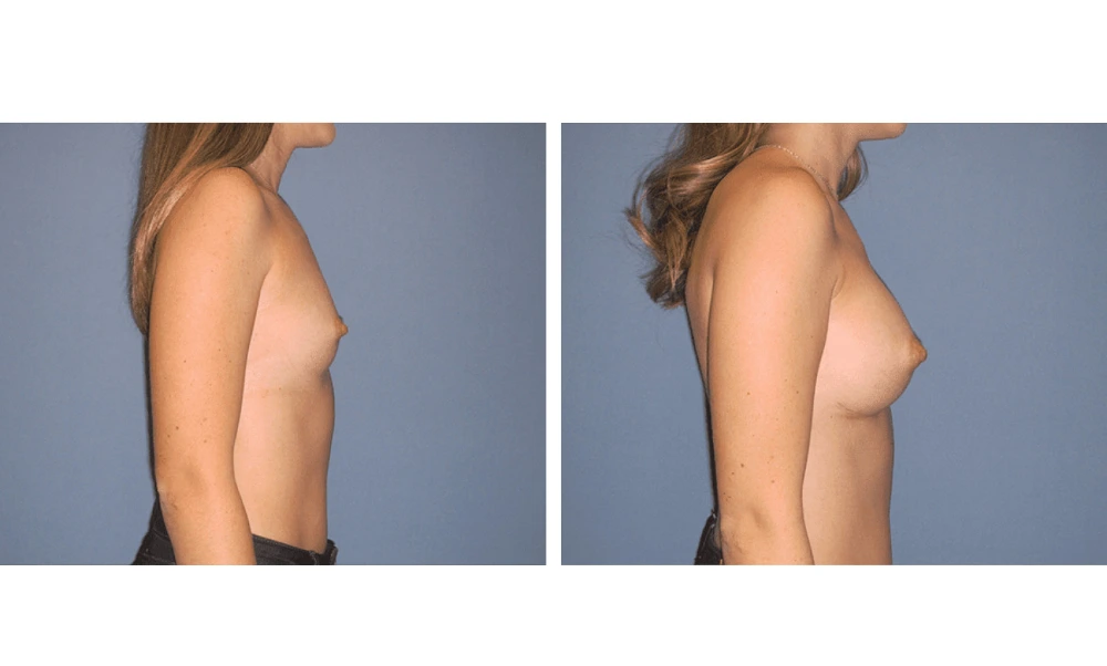 Breast Augmentation - Case 18 (3)