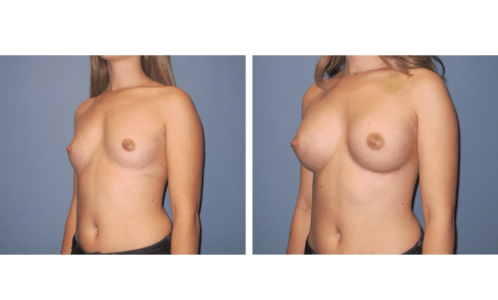 Breast Augmentation - Case 18 (4)