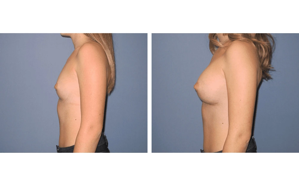 Breast Augmentation - Case 18 (5)
