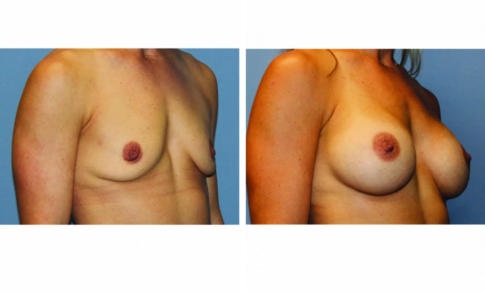 Breast Augmentation - Case 19 (2)