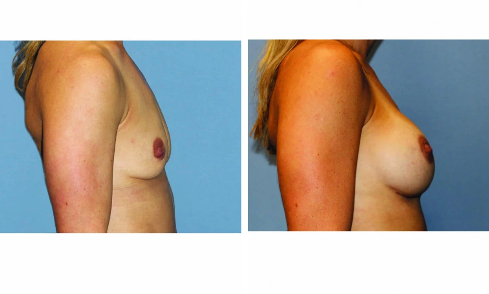 Breast Augmentation - Case 19 (3)