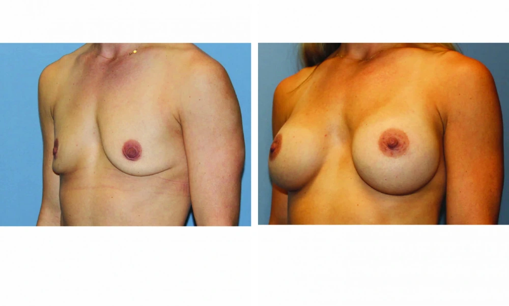 Breast Augmentation - Case 19 (4)