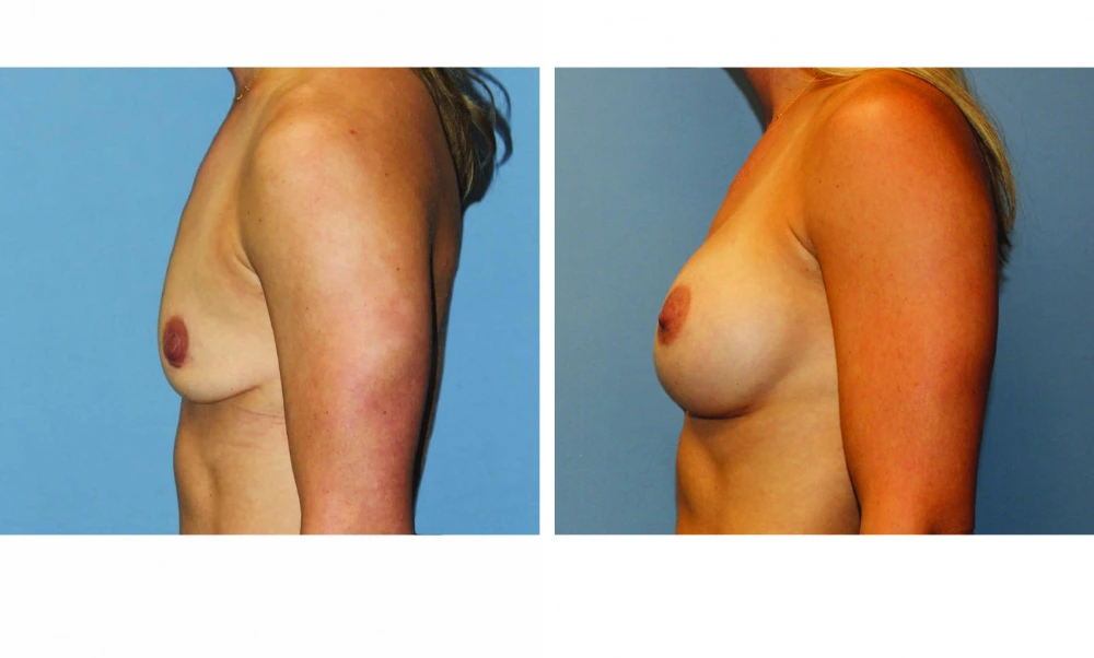 Breast Augmentation - Case 19 (5)