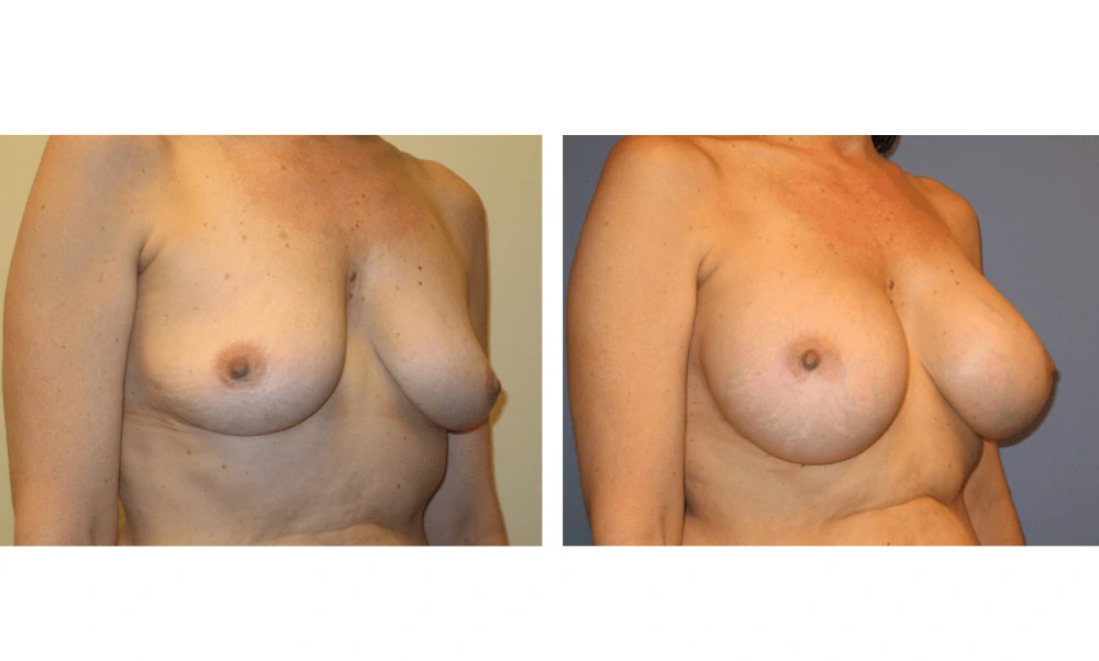 Breast Augmentation - Case 2 (2)