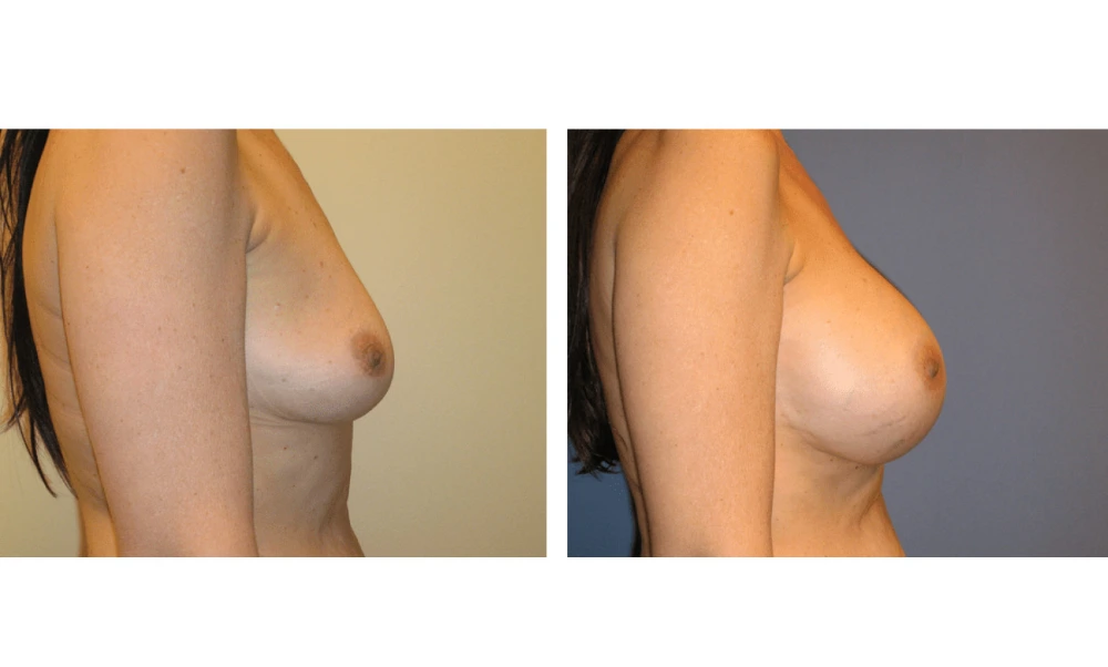 Breast Augmentation - Case 2 (3)