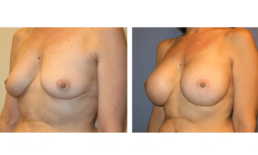 Breast Augmentation - Case 2 (4)