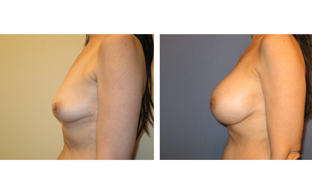 Breast Augmentation - Case 2 (5)