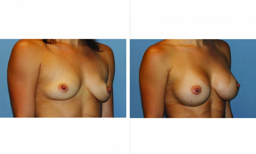 Breast Augmentation - Case 20 (2)