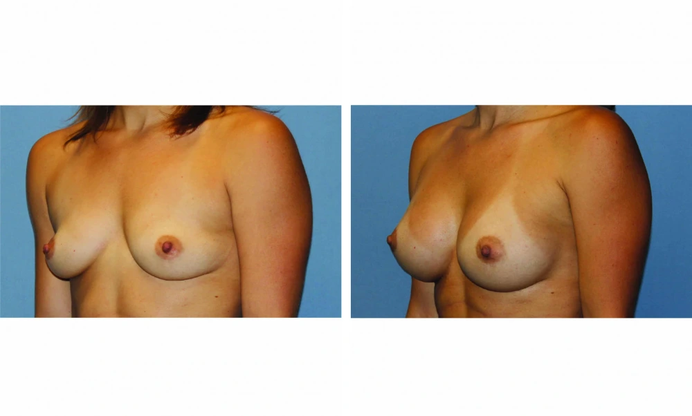 Breast Augmentation - Case 20 (4)