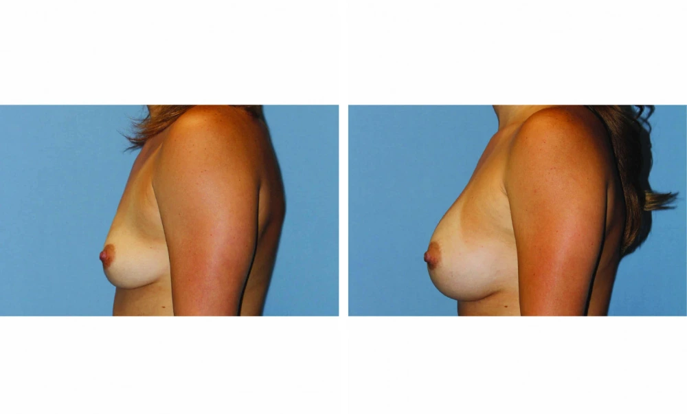 Breast Augmentation - Case 20 (5)