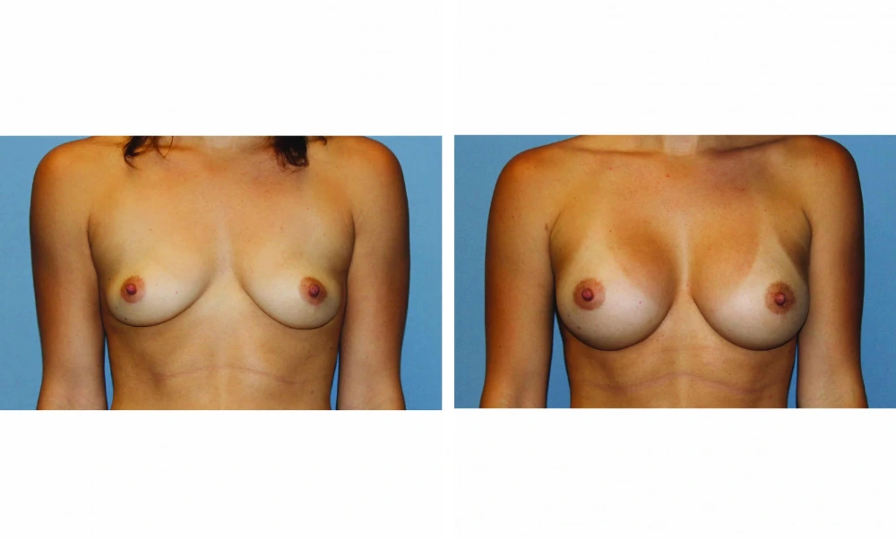 Breast Augmentation - Case 20