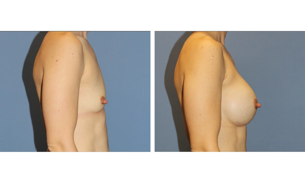 Breast Augmentation - Case 23 (3)