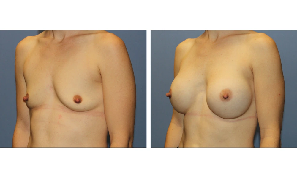 Breast Augmentation - Case 23 (4)
