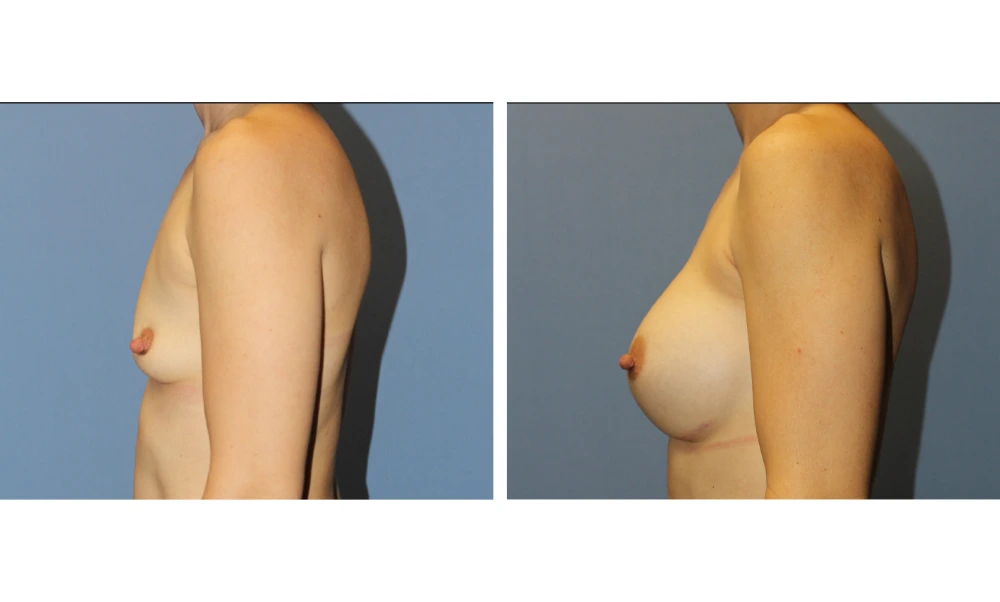 Breast Augmentation - Case 23 (5)