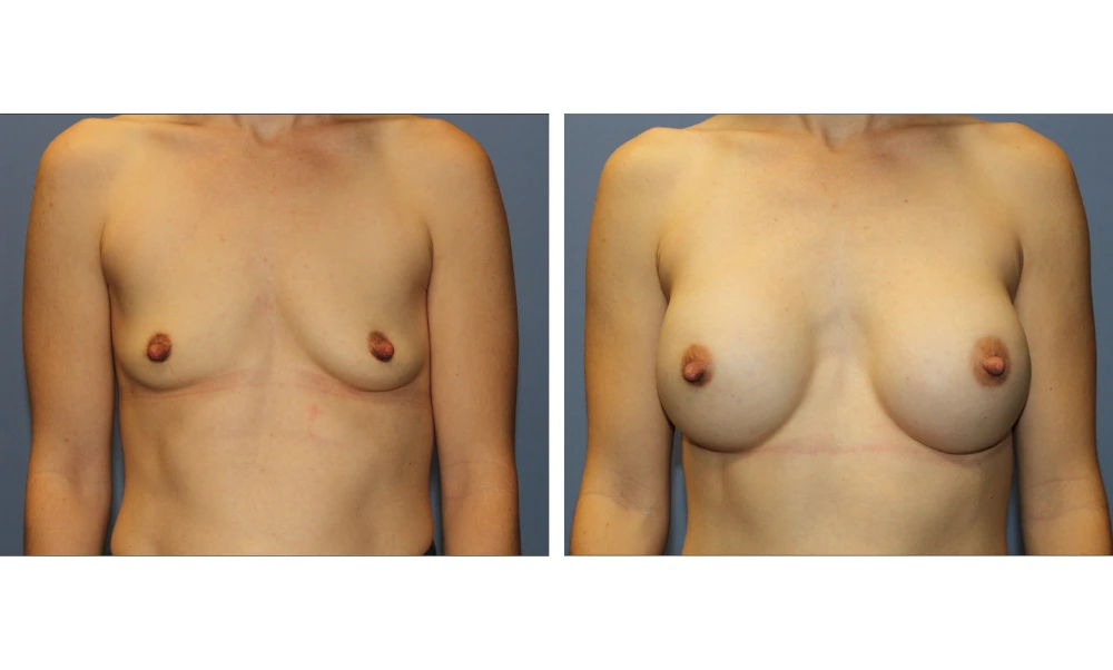 Breast Augmentation - Case 23