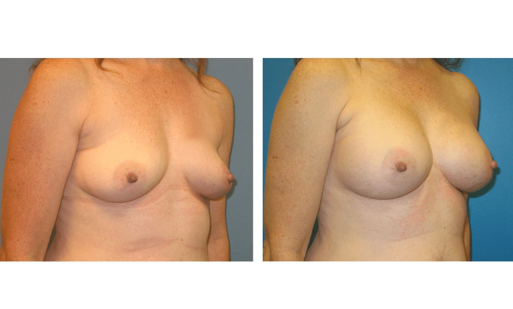 Breast Augmentation - Case 3 (2)