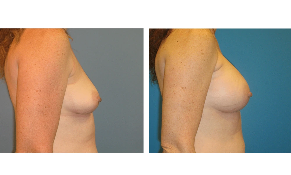 Breast Augmentation - Case 3 (3)