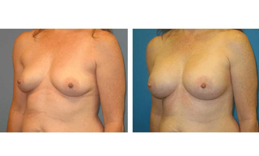 Breast Augmentation - Case 3 (4)