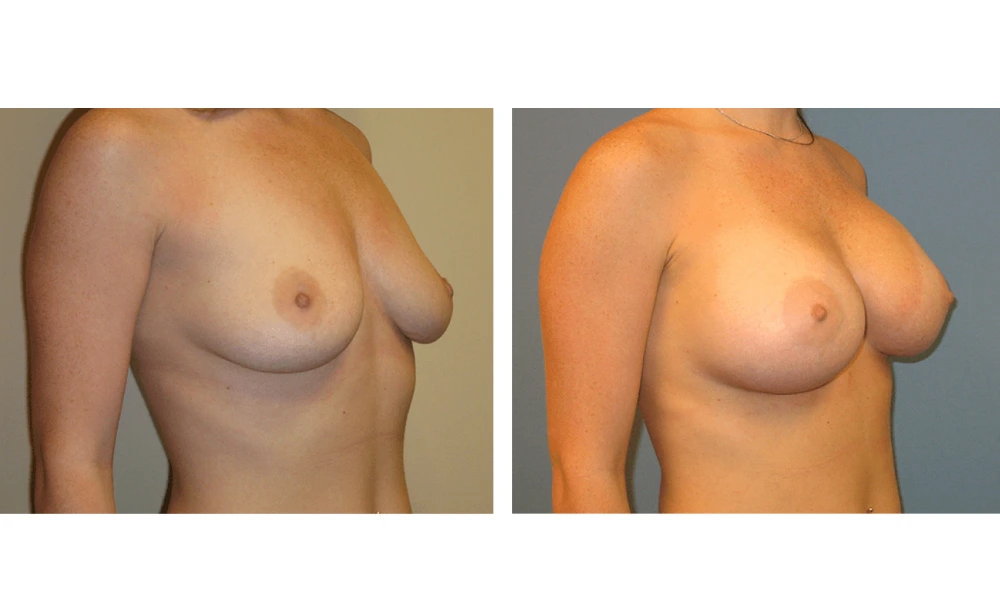 Breast Augmentation - Case 4 (2)
